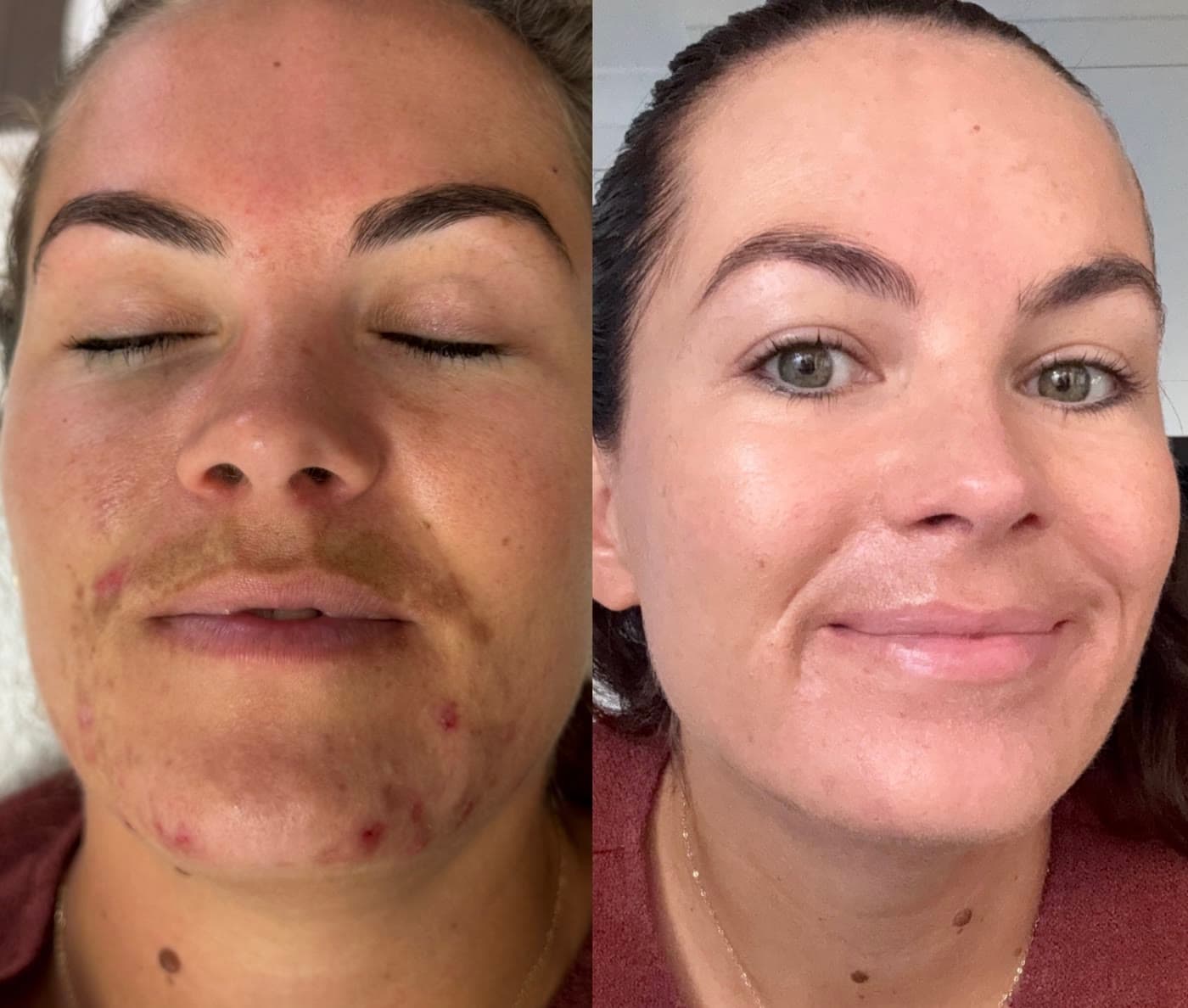 A ZAHARA client before and after a course of treatment for inflamed, congested acne