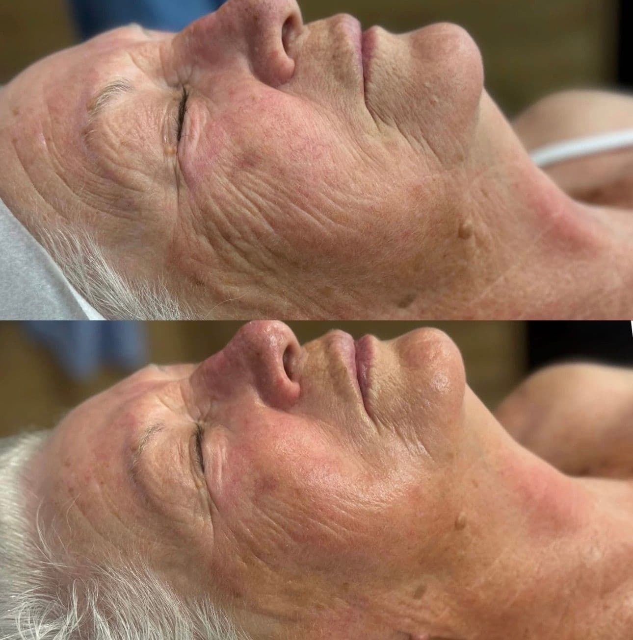 A ZAHARA client's cheek and jaw before and after a course of treatment for sun damage and lined skin