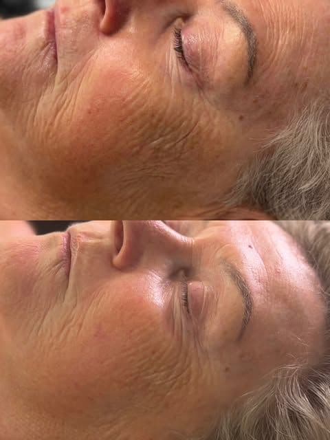 A ZAHARA client's cheek and eye area before and after a course of treatment for fine lines