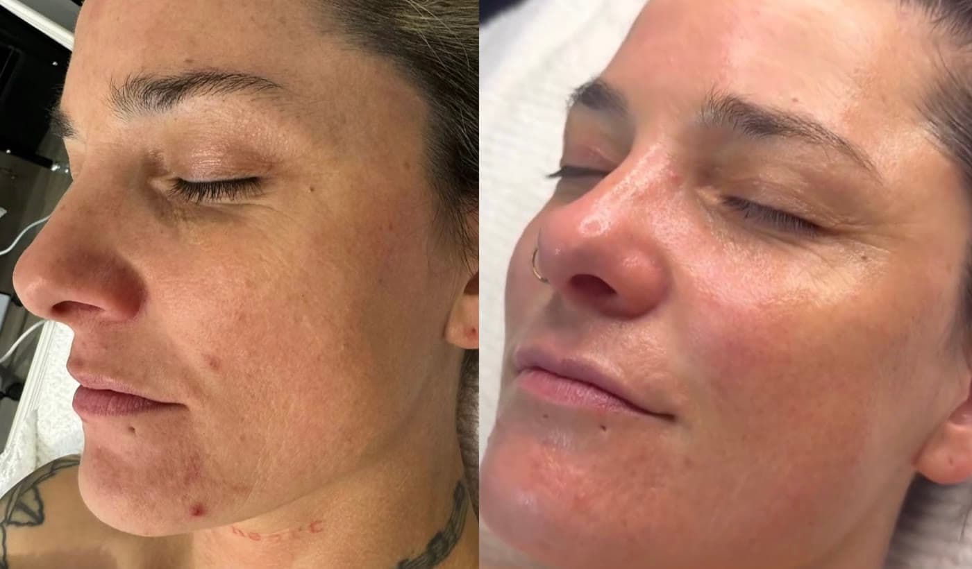 A ZAHARA client's cheek before and after a course of treatment for redness and open texture