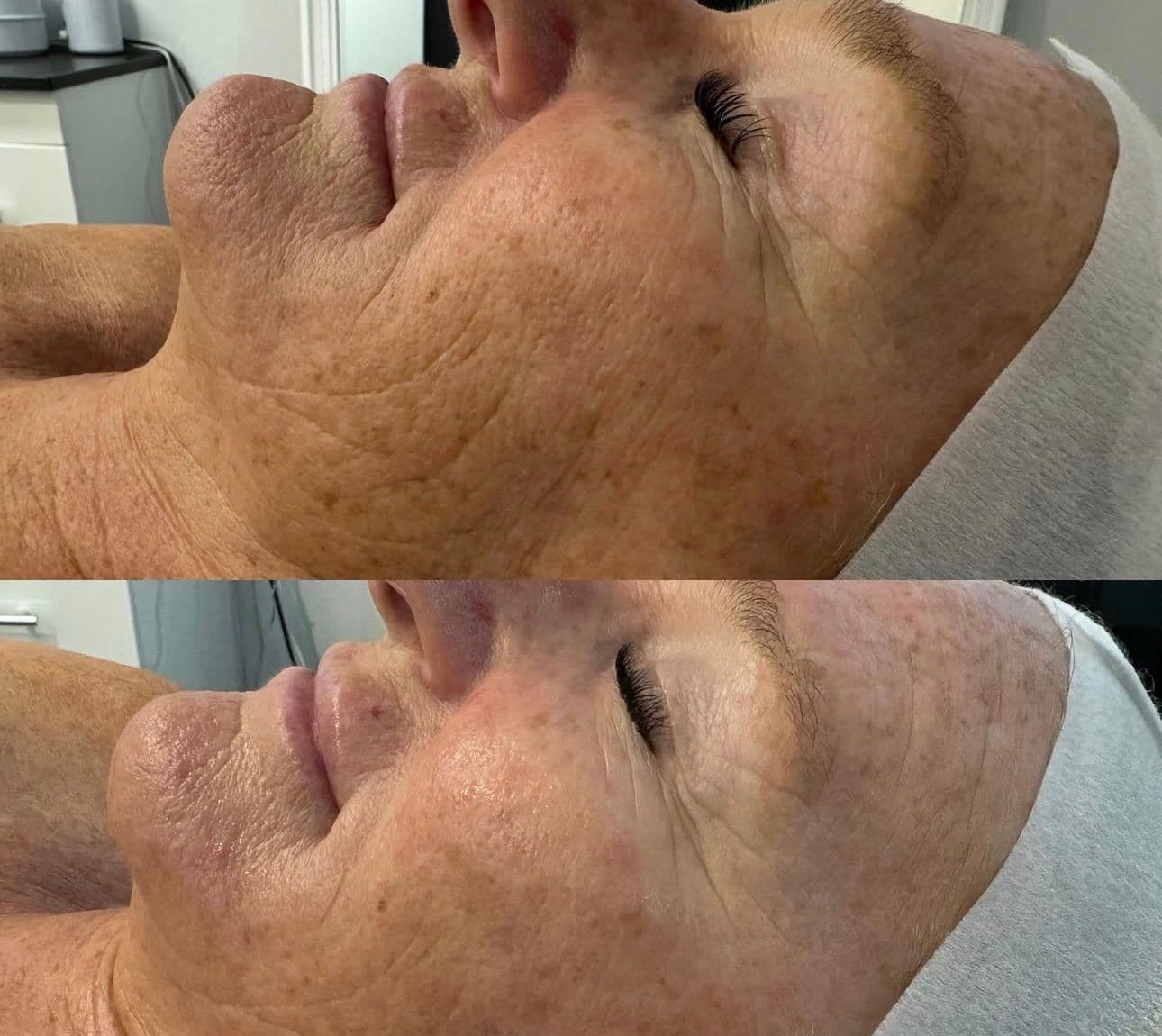 A ZAHARA client's jaw and neck before and after a course of treatment for crepey, sun damaged skin