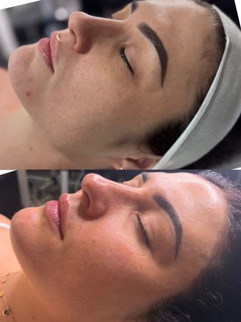 A ZAHARA client's cheek before and after a course of treatment for texture and pigmentation