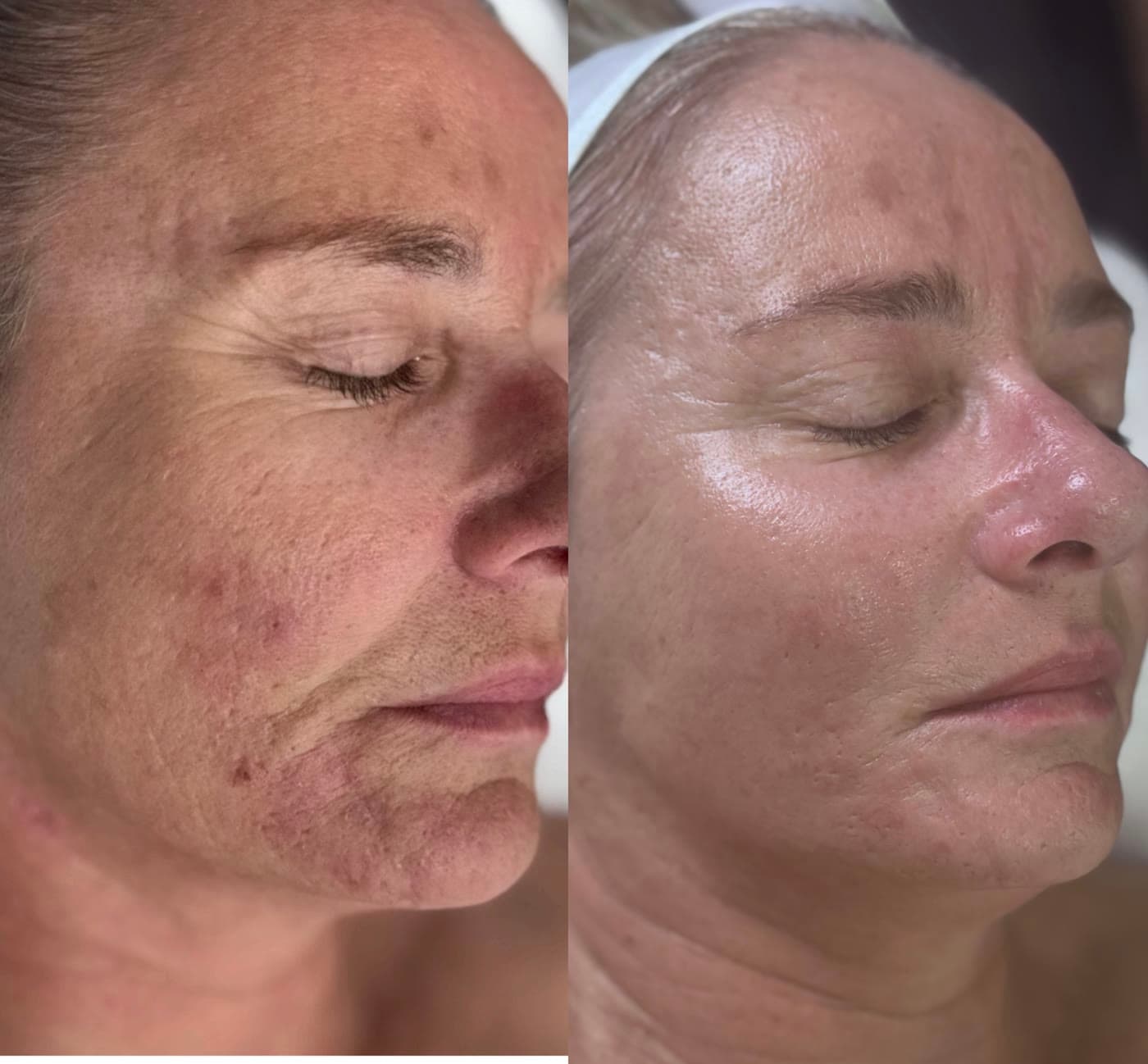 A ZAHARA client's cheek before and after a course of treatment for heavy sun damage and pigmentation