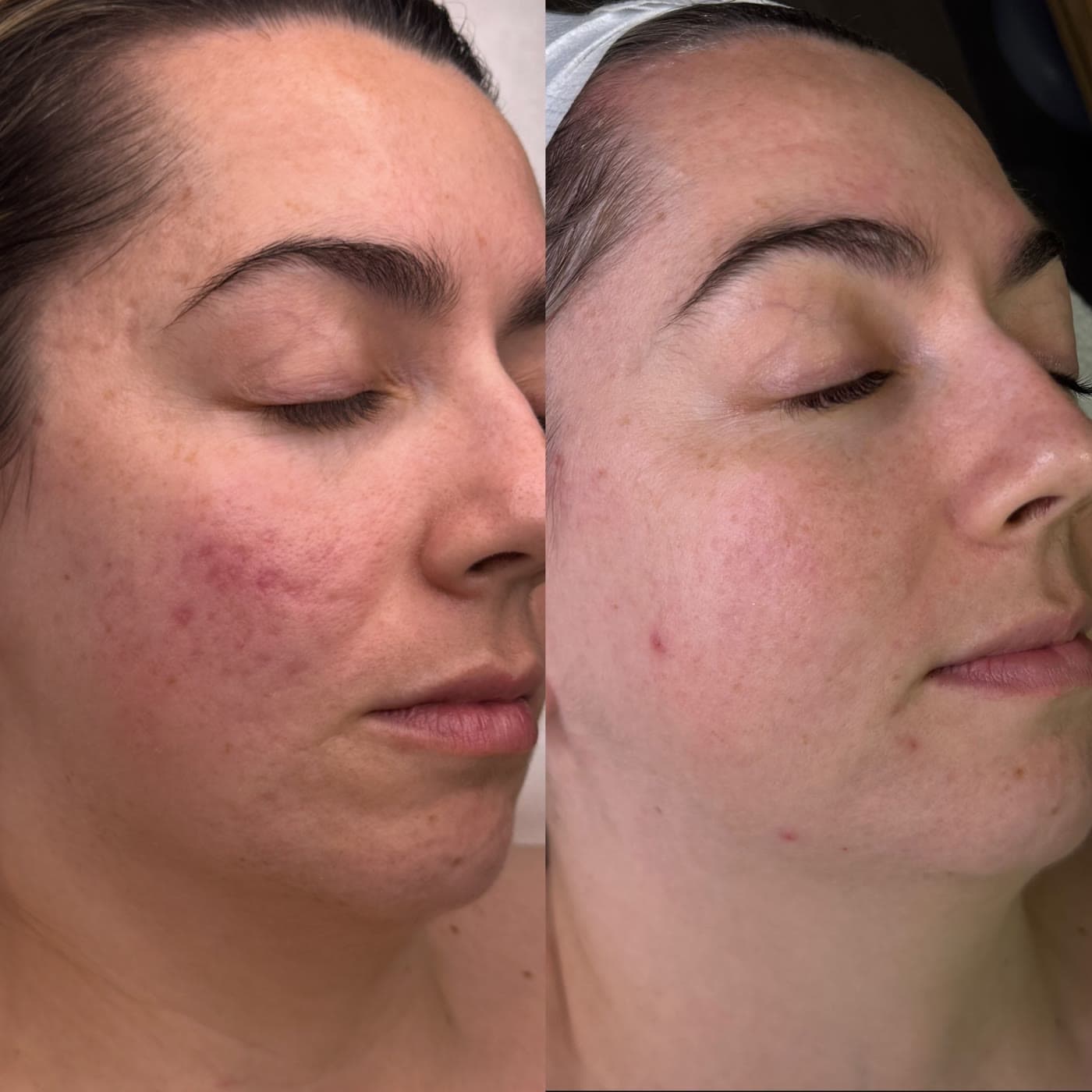 A ZAHARA client before and after a course of treatment for acne and facial redness
