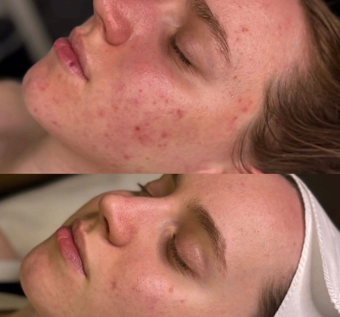 A ZAHARA client's cheek and jaw before and after a course of treatment for congested, inflamed skin